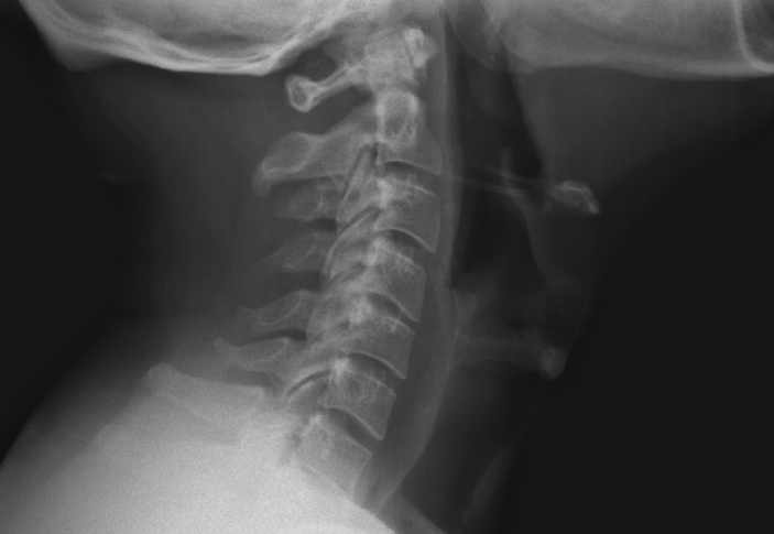 x-ray of throat